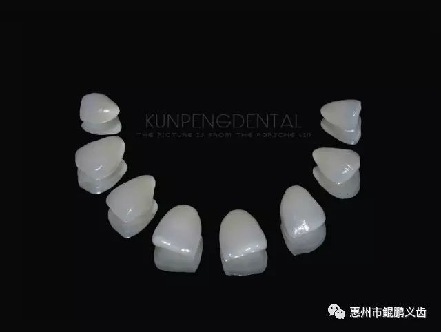 貝特福超薄貼面病例分享  